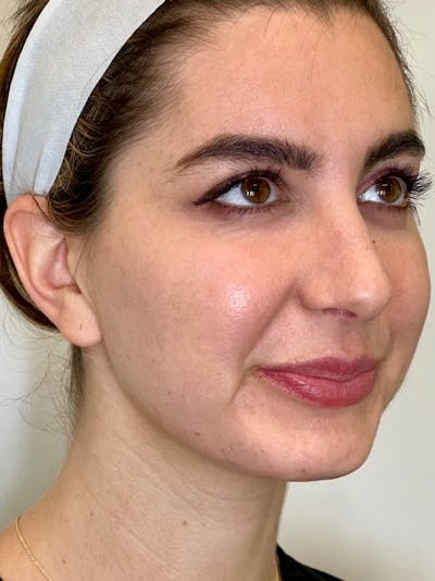 Nefertiti Neck Lift Before & After Gallery - Patient 265559 - Image 1