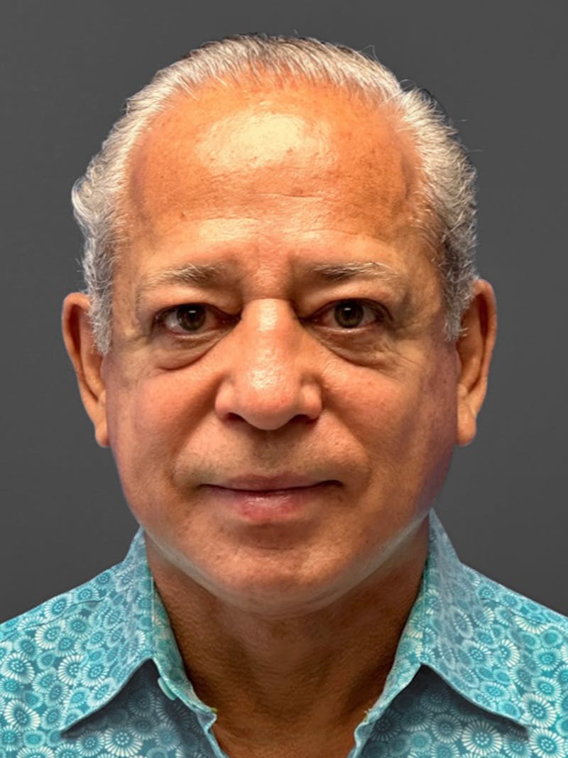Facelift Before & After Gallery - Patient 420019 - Image 2
