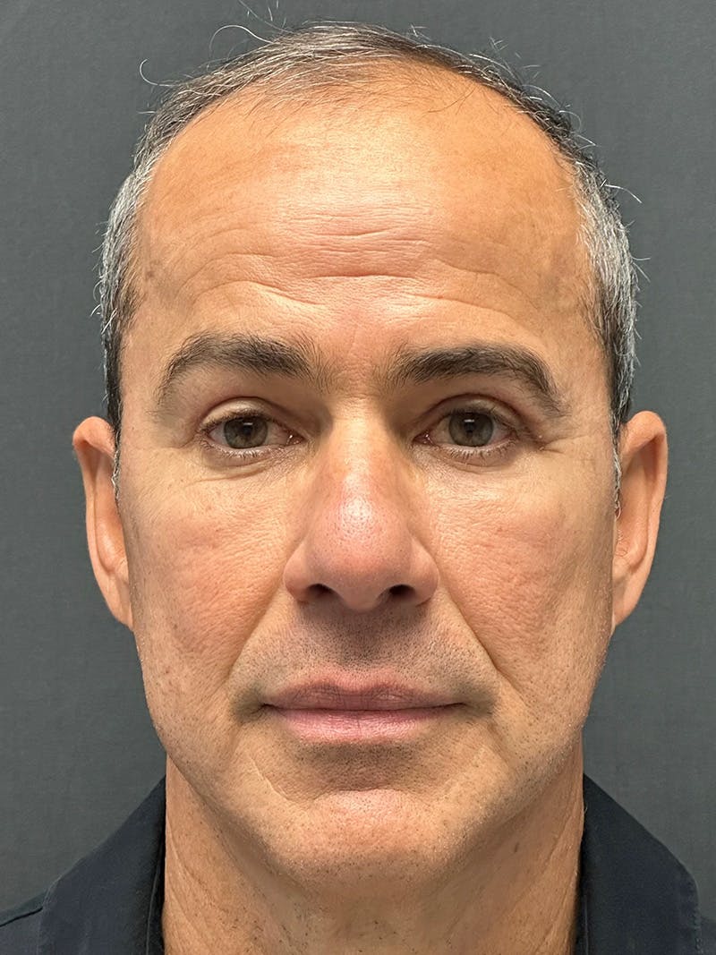 Male Face & Neck Before & After Gallery - Patient 180603 - Image 2