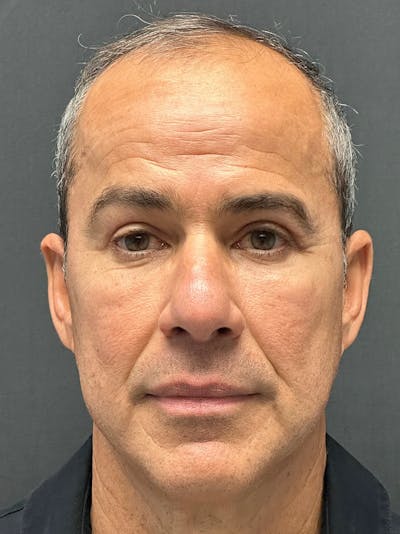 Male Face & Neck Before & After Gallery - Patient 180603 - Image 2