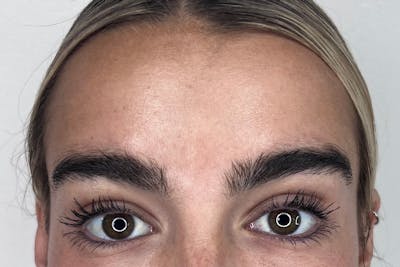 BOTOX Before & After Gallery - Patient 356623 - Image 2