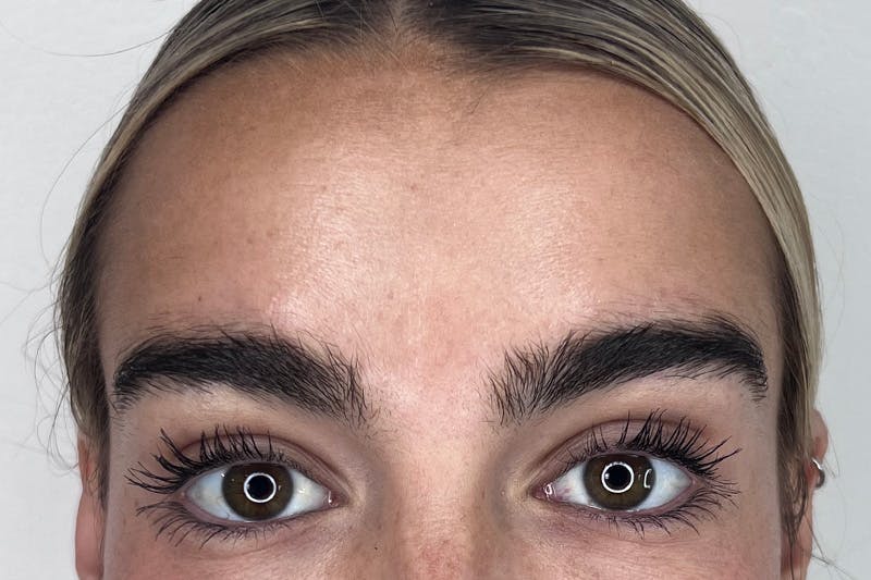 BOTOX Before & After Gallery - Patient 356623 - Image 2