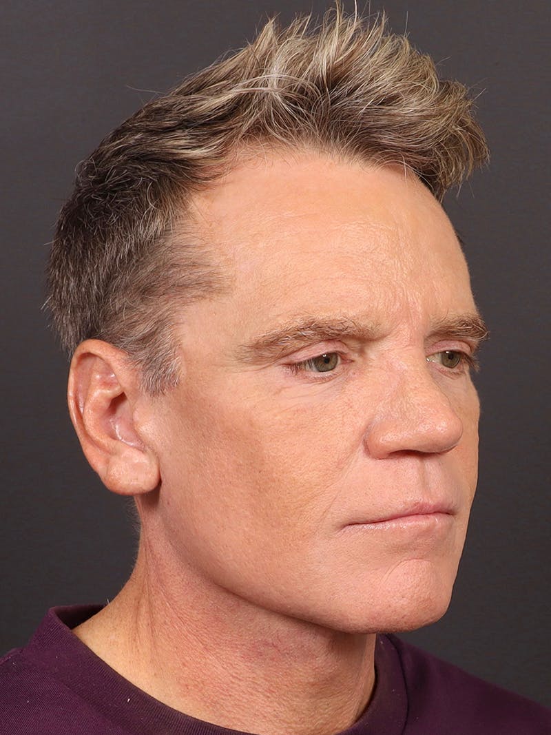 Facelift Before & After Gallery - Patient 345523 - Image 4