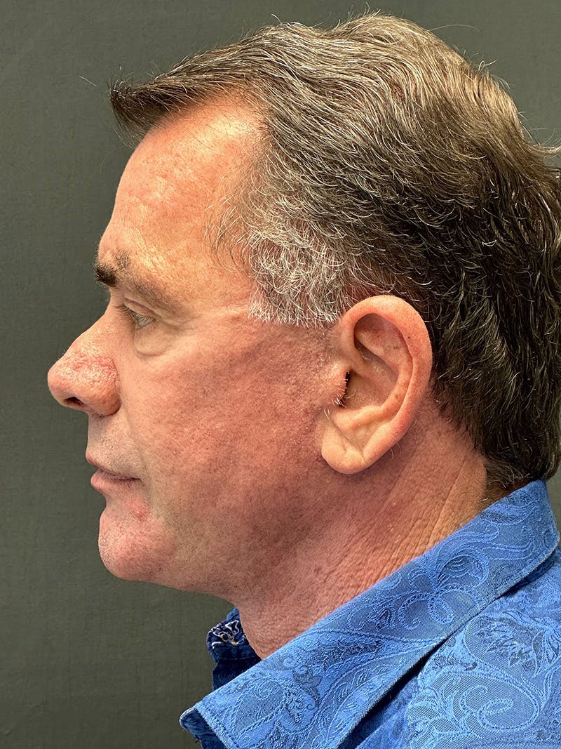 Facelift Before & After Gallery - Patient 267618 - Image 4