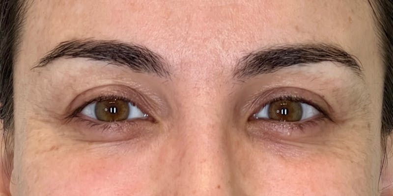 Dysport Before & After Gallery - Patient 349832 - Image 3