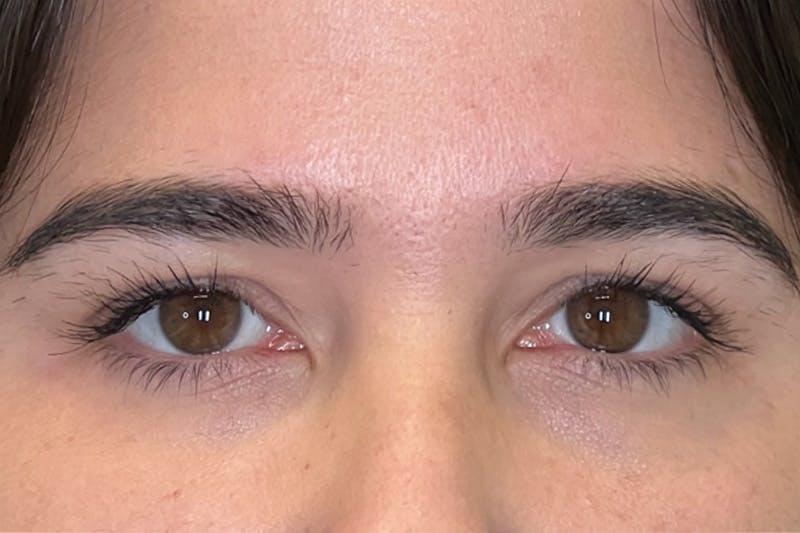 Dysport Before & After Gallery - Patient 310845 - Image 5
