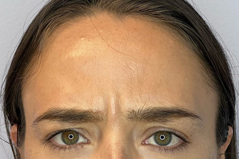 BOTOX Before & After Gallery - Patient 983773 - Image 5