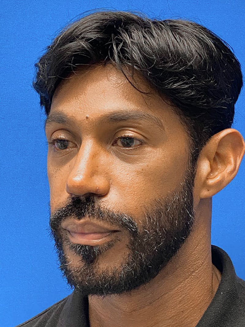 Primary Rhinoplasty Before & After Gallery - Patient 899073 - Image 6