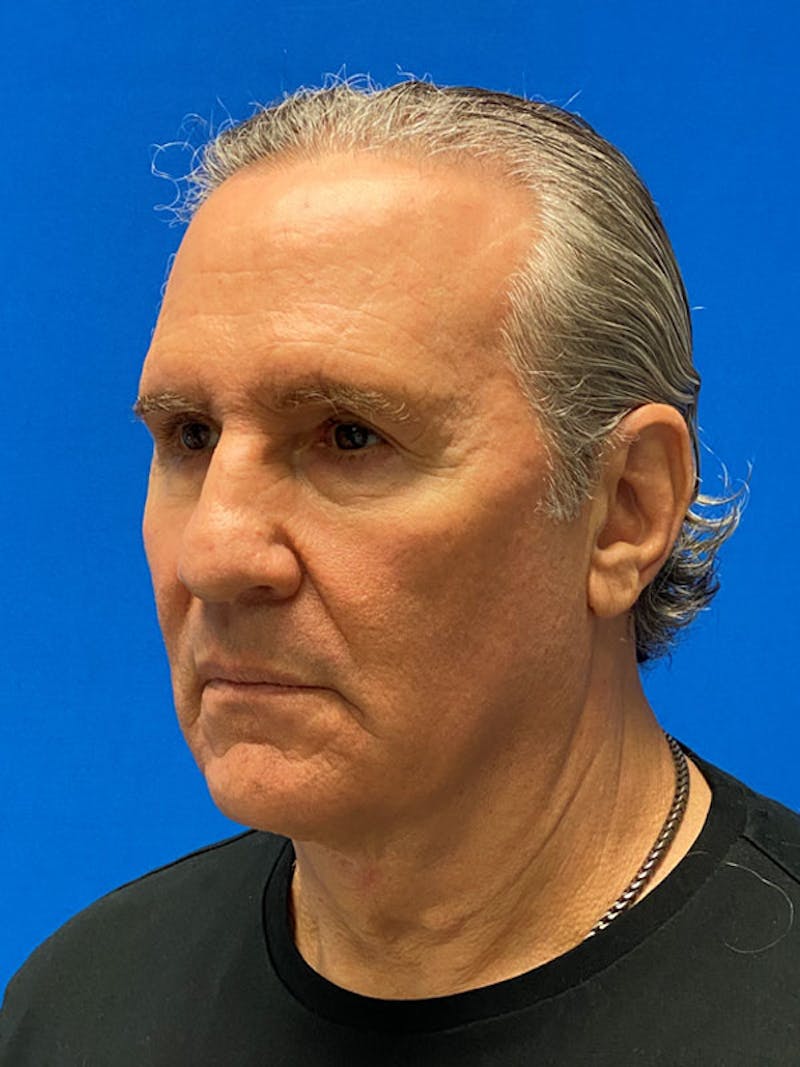 Facelift Before & After Gallery - Patient 359956 - Image 3
