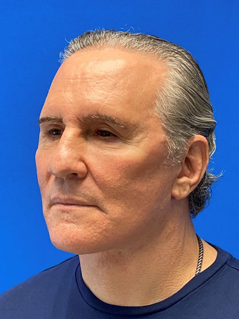 Facelift Before & After Gallery - Patient 359956 - Image 4