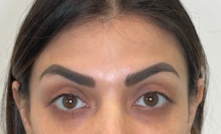 Dysport Before & After Gallery - Patient 309774 - Image 8
