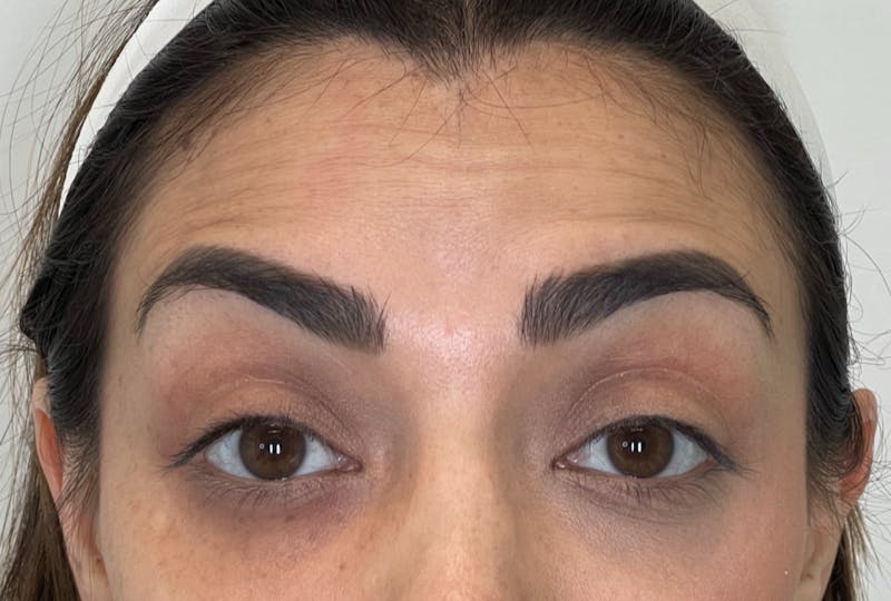 Dysport Before & After Gallery - Patient 309774 - Image 7