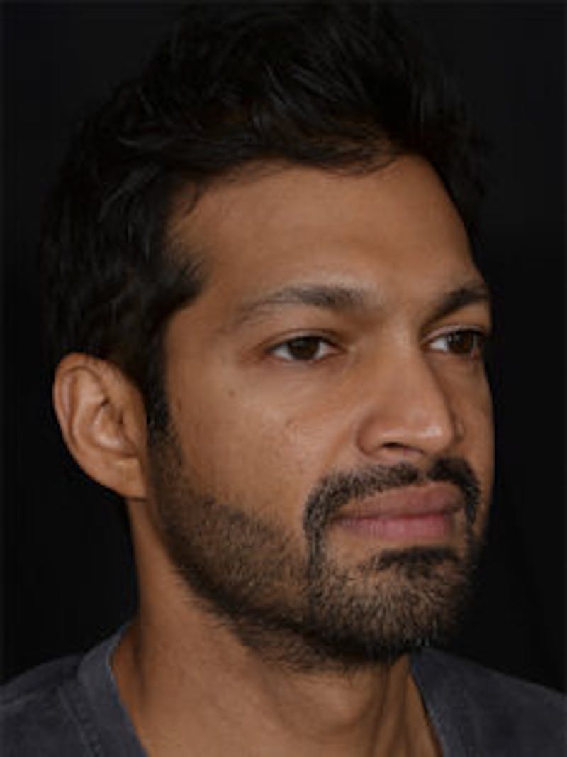 Male Face & Neck Before & After Gallery - Patient 452117 - Image 3