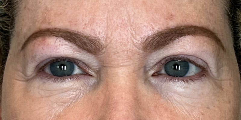 Dysport Before & After Gallery - Patient 139921 - Image 1