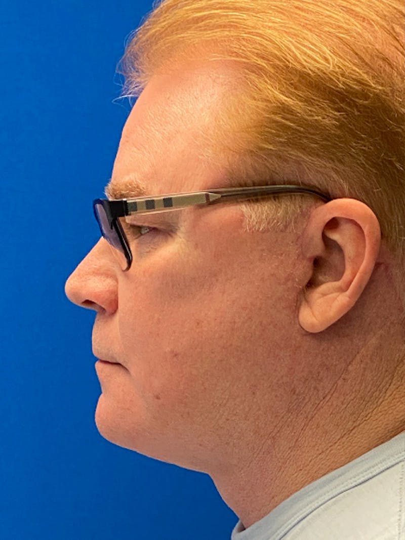 Facelift Before & After Gallery - Patient 153770 - Image 8