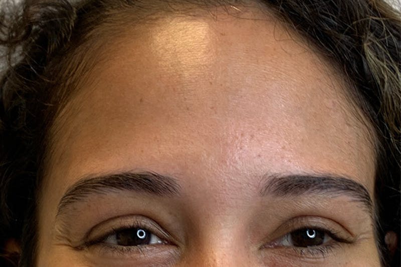 BOTOX Before & After Gallery - Patient 246260 - Image 3