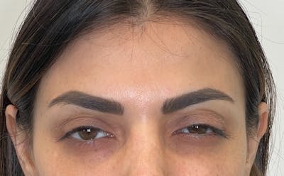 Dysport Before & After Gallery - Patient 309774 - Image 2