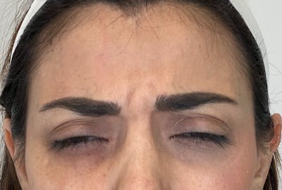 Dysport Before & After Gallery - Patient 309774 - Image 1