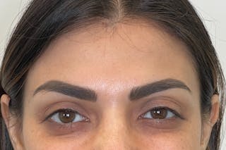 Dysport Before & After Gallery - Patient 309774 - Image 4