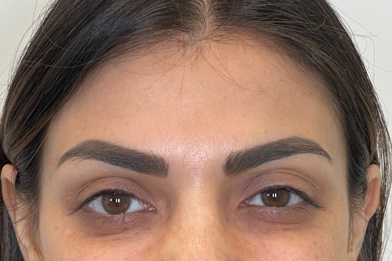Dysport Before & After Gallery - Patient 309774 - Image 4