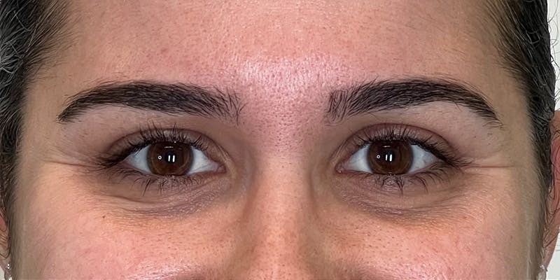 Dysport Before & After Gallery - Patient 165924 - Image 1