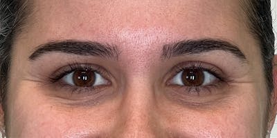 Dysport Before & After Gallery - Patient 165924 - Image 1