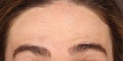 Dysport Before & After Gallery - Patient 255060 - Image 1