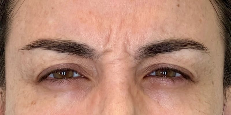 Dysport Before & After Gallery - Patient 349832 - Image 1