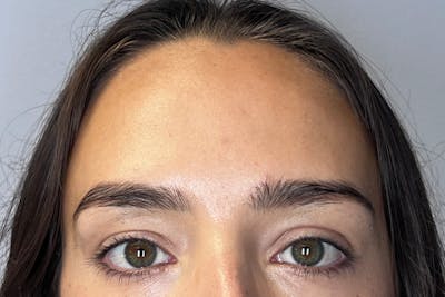 BOTOX Before & After Gallery - Patient 983773 - Image 2