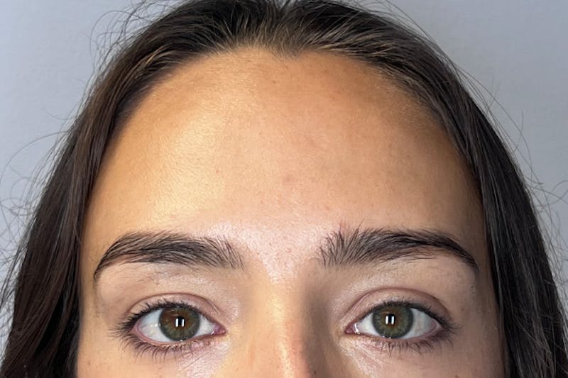 BOTOX Before & After Gallery - Patient 983773 - Image 2