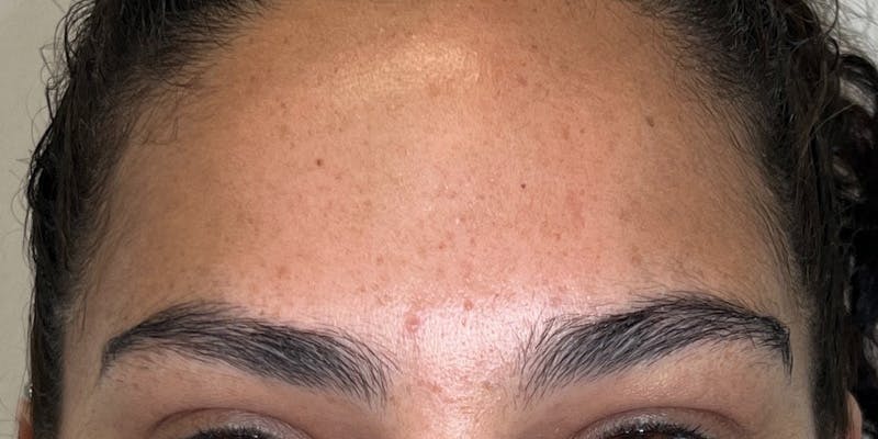 Dysport Before & After Gallery - Patient 120224 - Image 2
