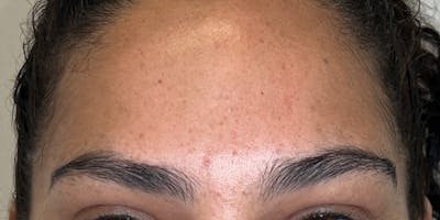 Dysport Before & After Gallery - Patient 120224 - Image 2