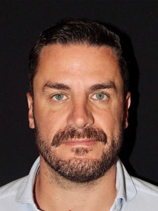 Male Face & Neck Before & After Gallery - Patient 114598 - Image 2