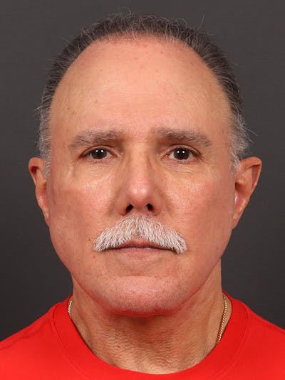 Male Face & Neck Before & After Gallery - Patient 374888 - Image 2