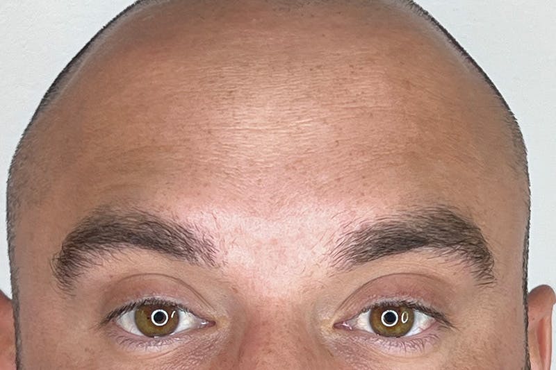BOTOX Before & After Gallery - Patient 295976 - Image 2
