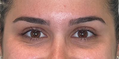 Dysport Before & After Gallery - Patient 165924 - Image 2