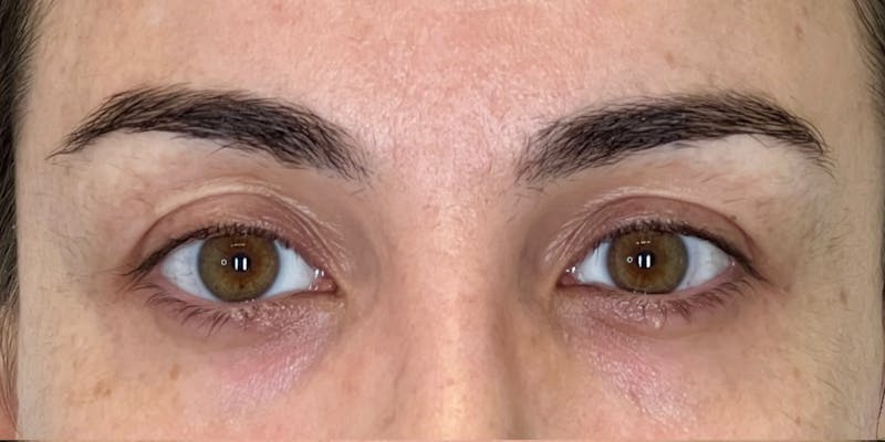 Dysport Before & After Gallery - Patient 349832 - Image 5