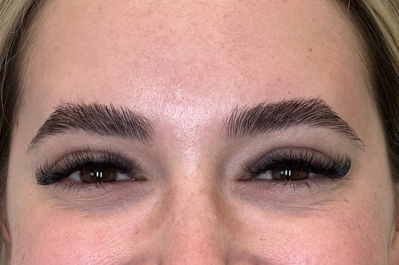 BOTOX Before & After Gallery - Patient 629113 - Image 4