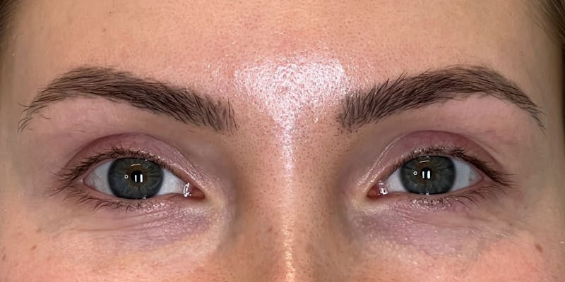BOTOX Before & After Gallery - Patient 228341 - Image 6