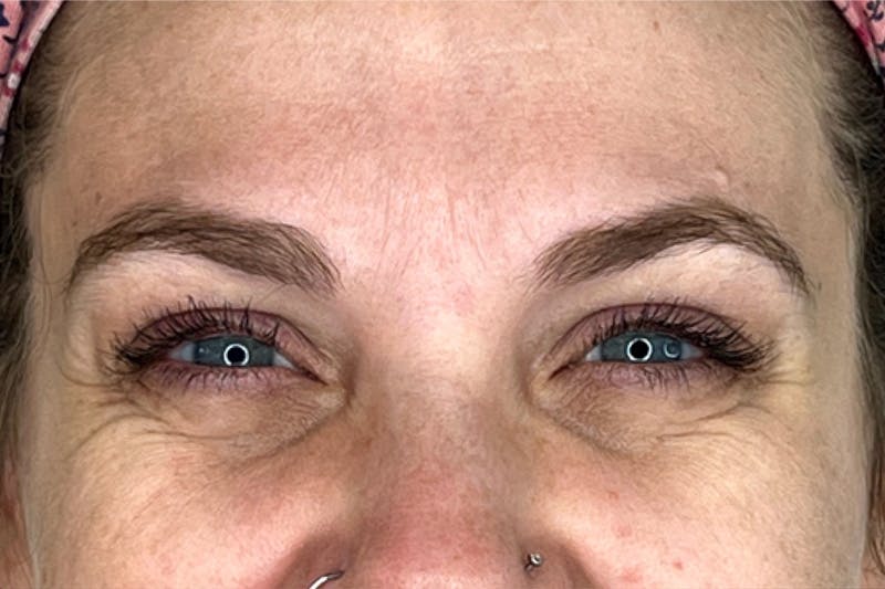 BOTOX Before & After Gallery - Patient 283220 - Image 5