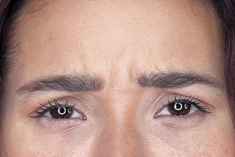 Dysport Before & After Gallery - Patient 116764 - Image 5