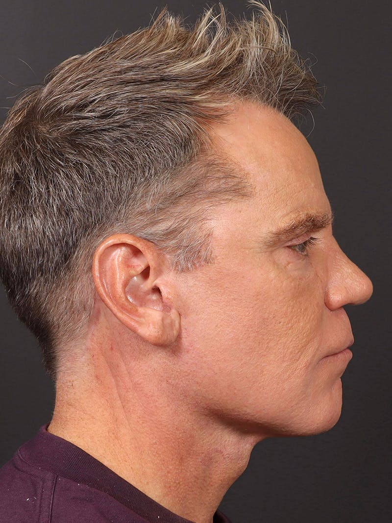 Facelift Before & After Gallery - Patient 345523 - Image 6