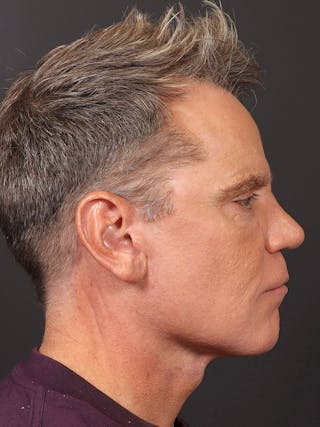 Facelift Before & After Gallery - Patient 345523 - Image 6