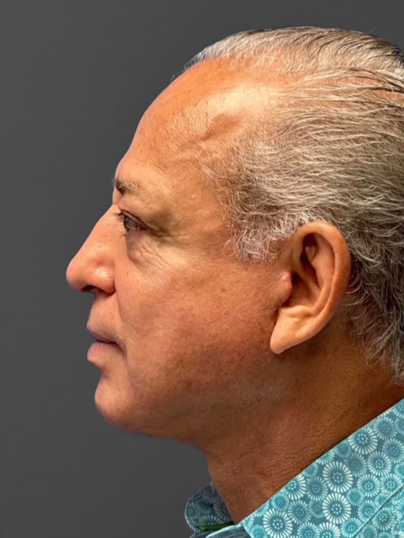 Facelift Before & After Gallery - Patient 420019 - Image 6