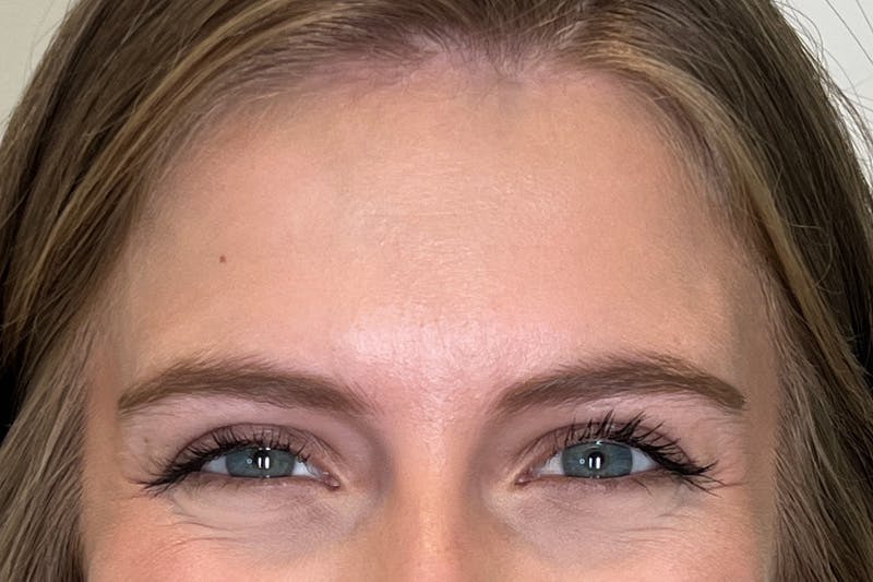 BOTOX Before & After Gallery - Patient 913658 - Image 7