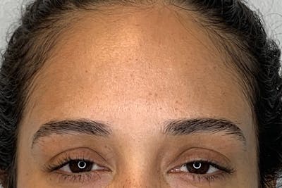 BOTOX Before & After Gallery - Patient 246260 - Image 2