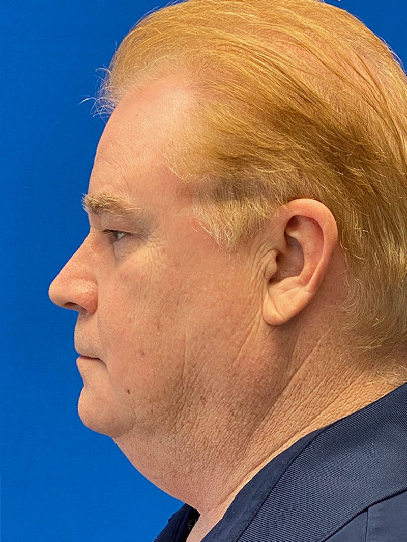 Facelift Before & After Gallery - Patient 153770 - Image 7