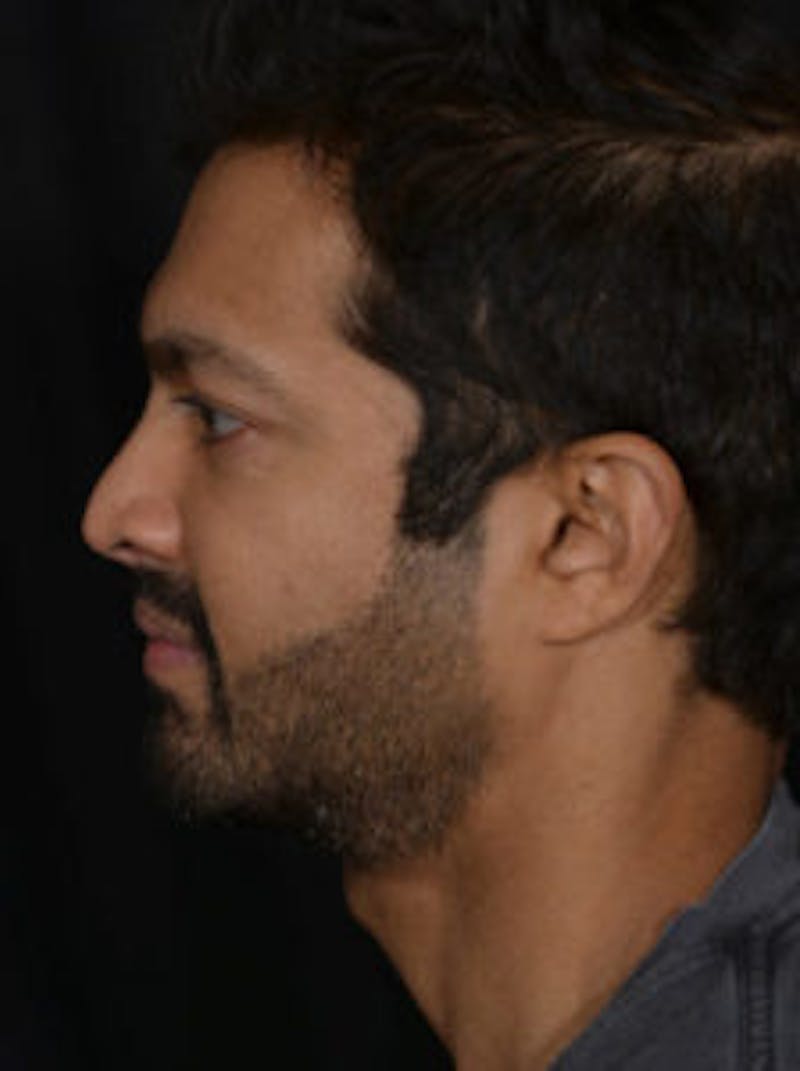 Male Face & Neck Before & After Gallery - Patient 452117 - Image 9