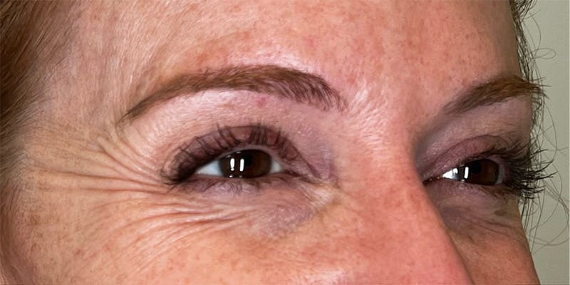 Dysport Before & After Gallery - Patient 222436 - Image 1
