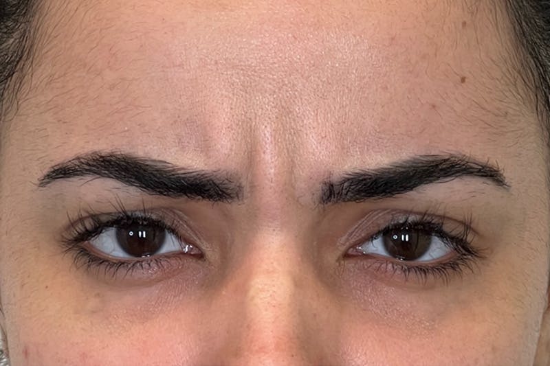 Dysport Before & After Gallery - Patient 168374 - Image 1